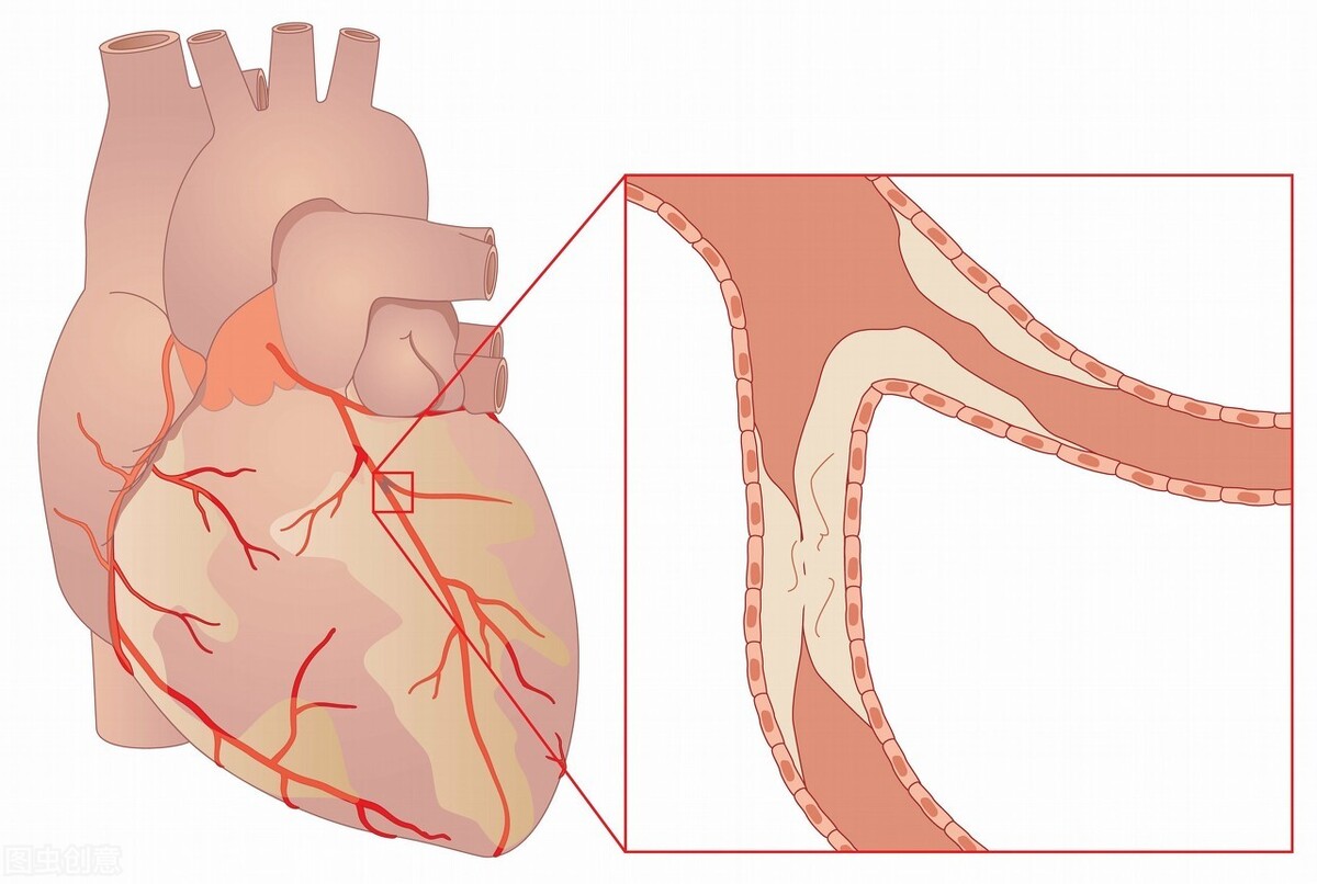 冠状动脉 什么是冠状动脉造影？冠状动脉造影后要记住的四件事