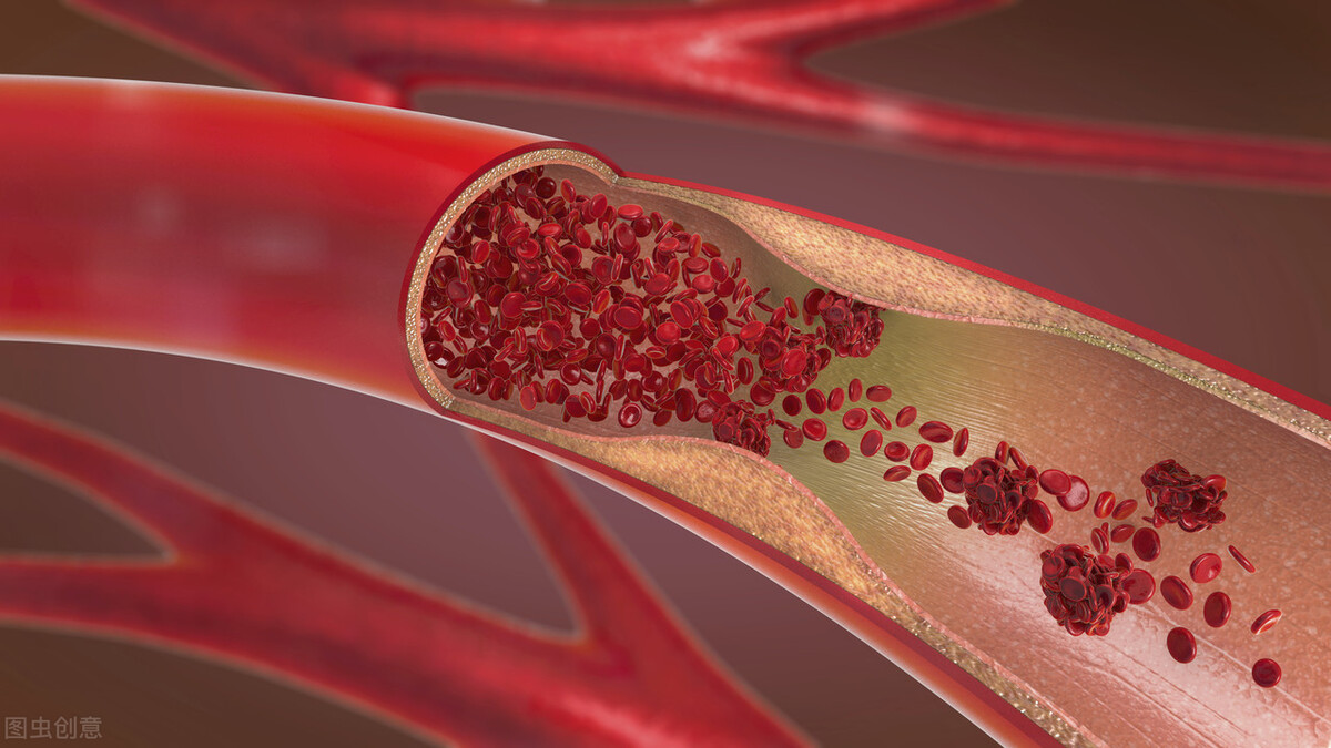 血栓是坏习惯养出来的，这4个不良行为赶紧改掉，对照一下吧
