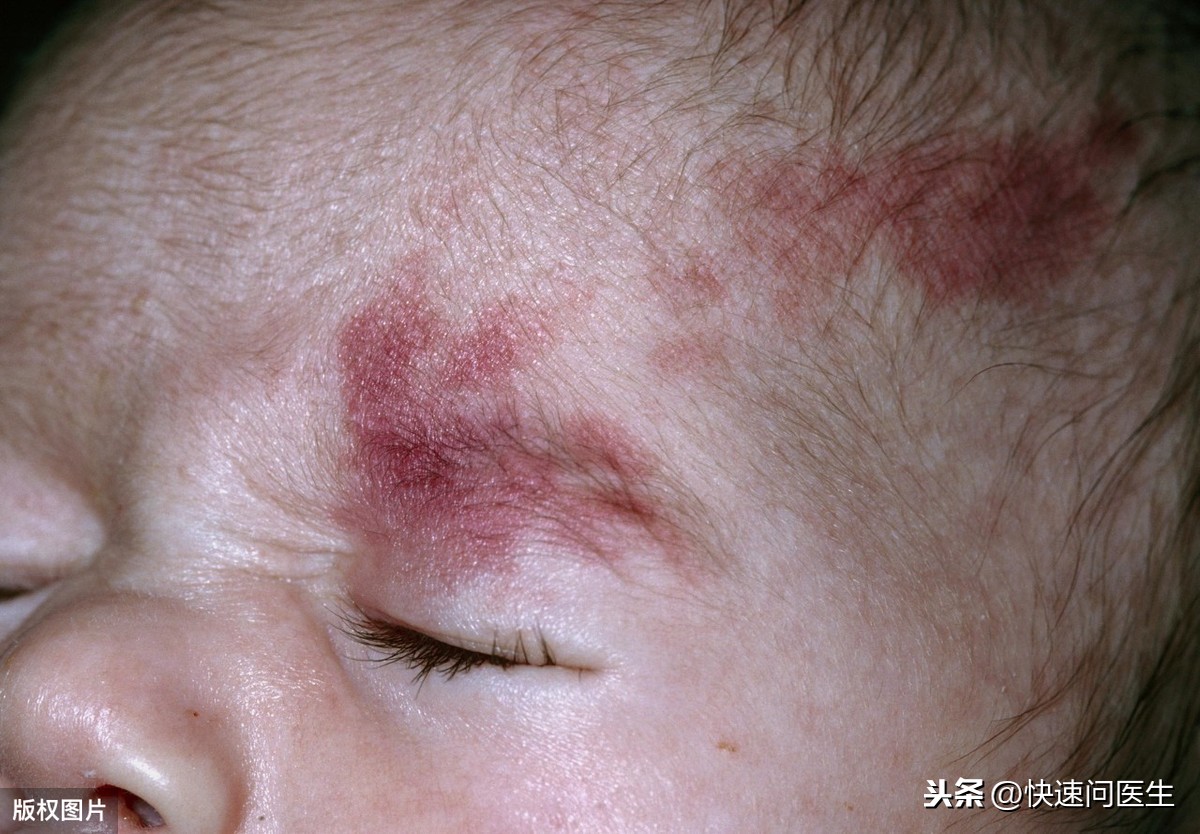 身上突然长了很多小红痣是什么原因？警惕：这两种痣