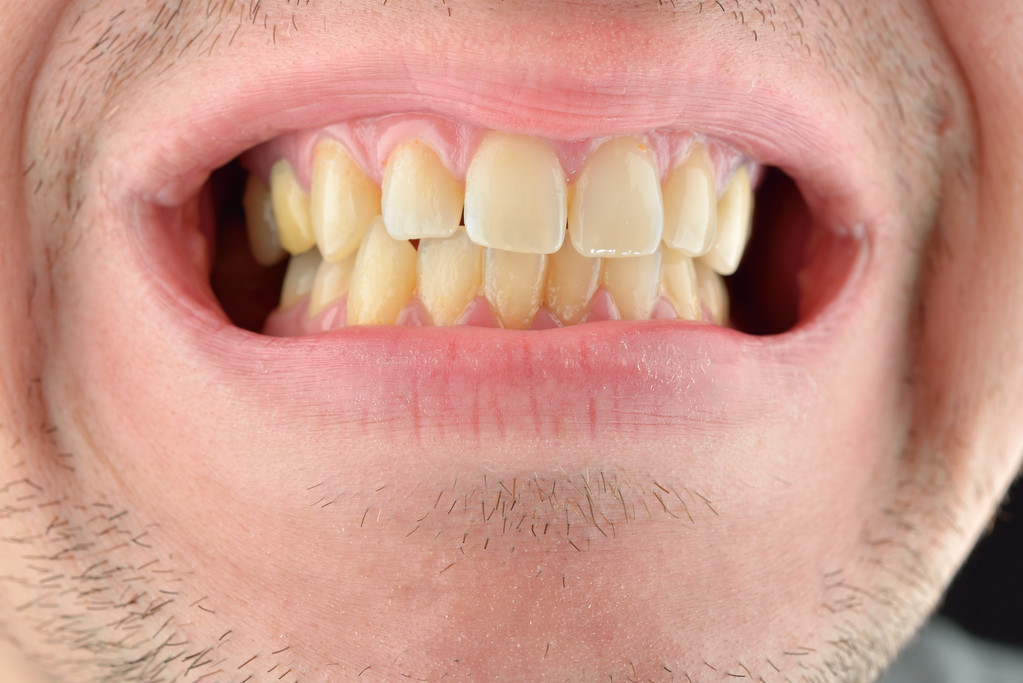 如何去除牙齿上的黑渍？牙医给你推荐几种有效办法