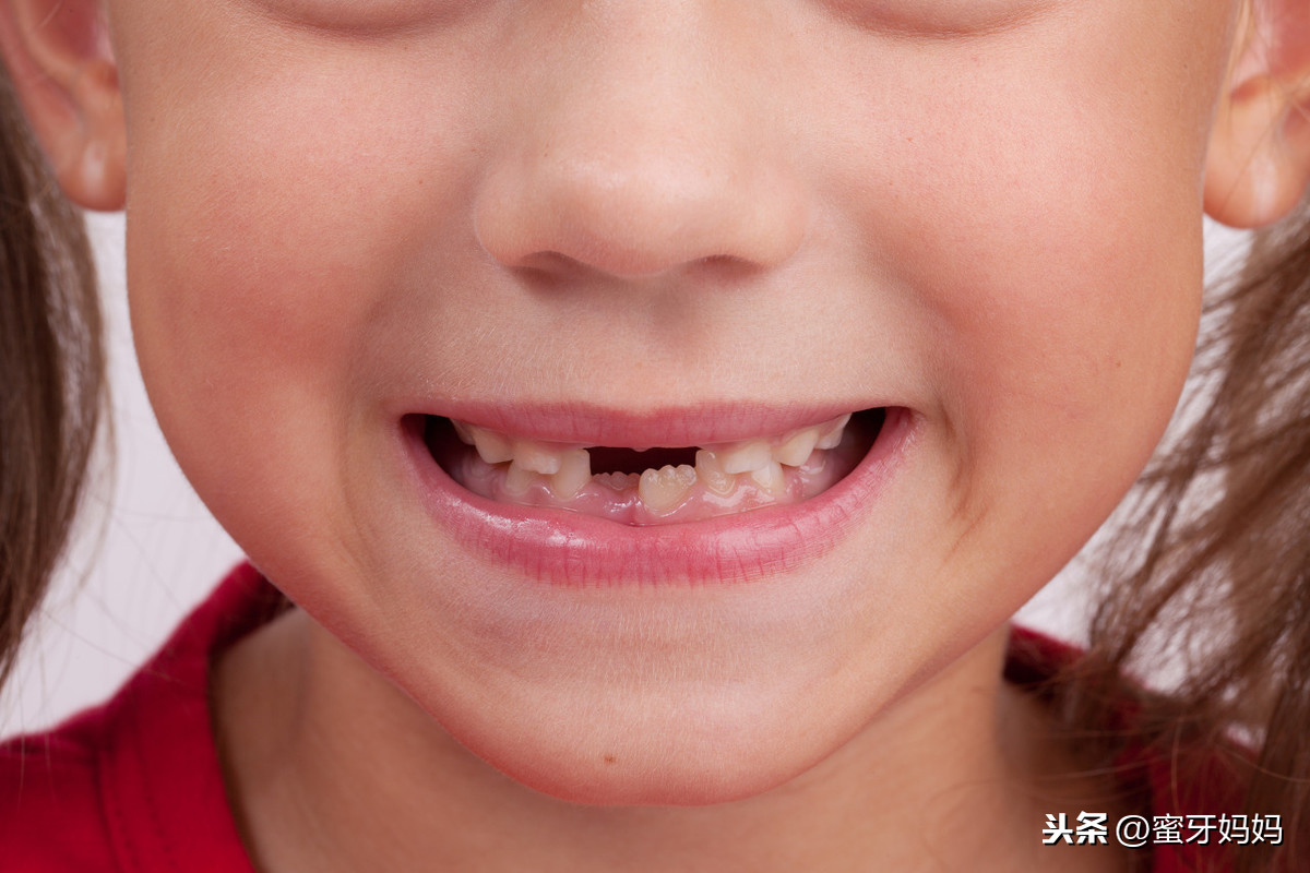 2 乳牙的龋病特点-儿童口腔科图谱-医学