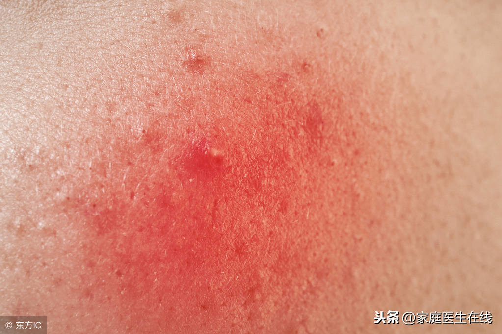 皮肤突然变得红肿，是皮肤病吗？三个诱因都不容忽视