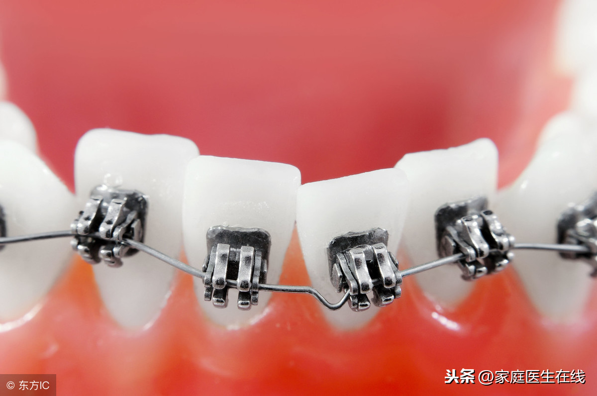 做牙齿矫正要注意什么？讲清4个误区，让你深入了解牙齿矫正
