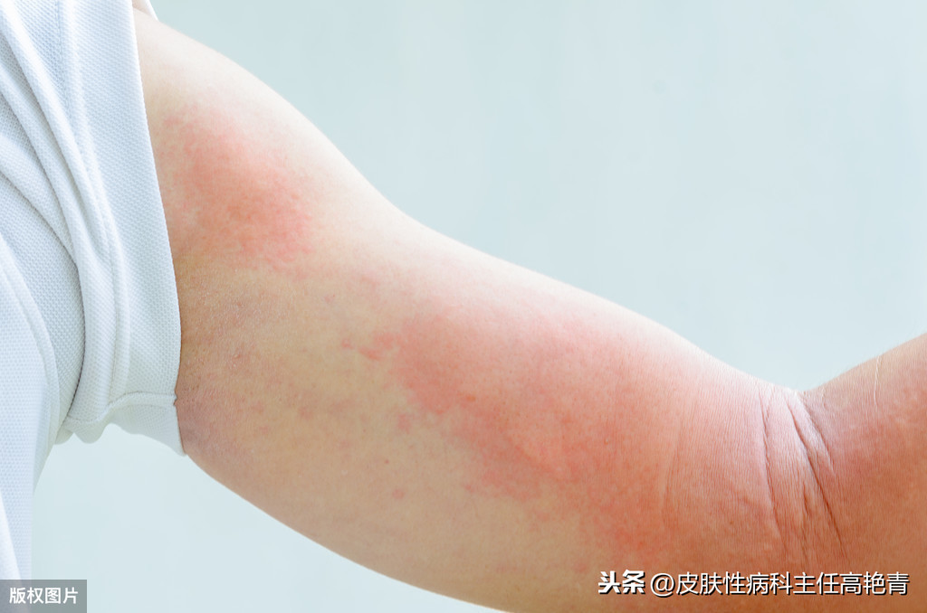 过敏性荨麻疹是怎么回事，一篇文章让你正确认识它