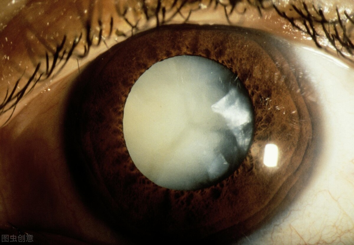 白内障：米国眼科学会の公式最新情報をごらんください | 自由が丘 清澤眼科
