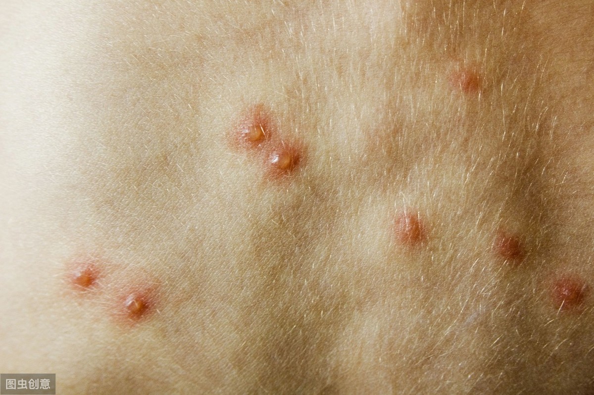 带状疱疹有哪些早期表现？当你的皮肤出现这些症状时就需注意了