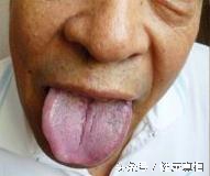 舌头青紫色是怎么回事呢？