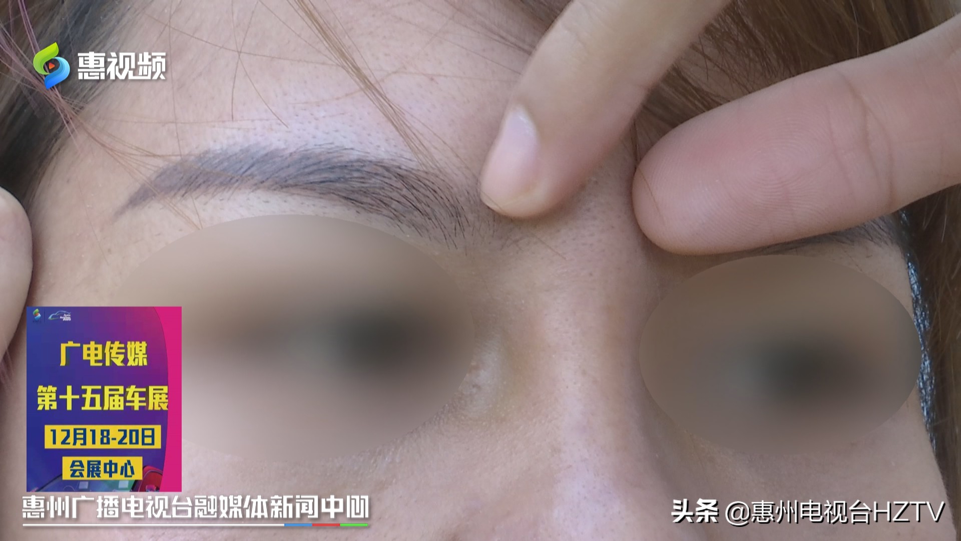 惠州：女子隆鼻后不适要退款，尚妍医疗美容称不满意可走鉴定程序