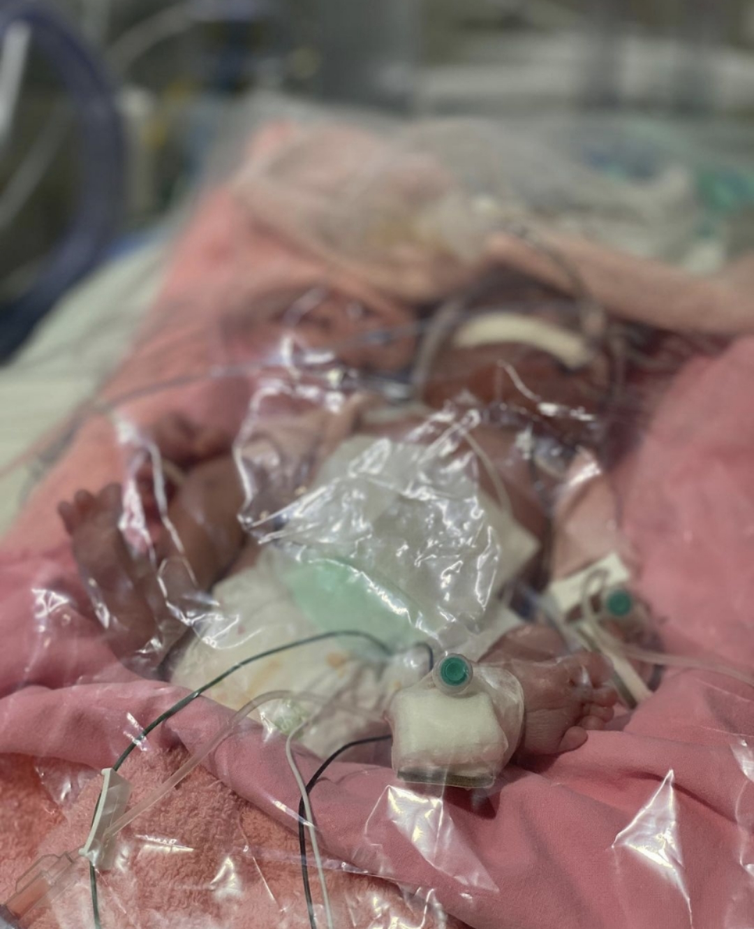 余文乐晒女儿刚出生时模样，宝宝又黑又虚弱，浑身插满管子惹人疼