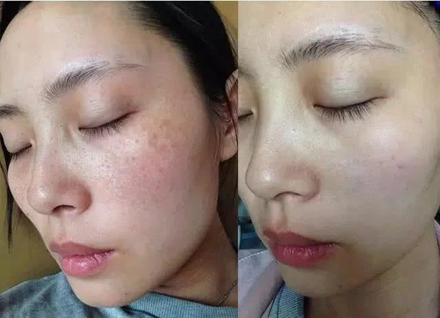 脸上的斑点终于滚蛋了!亲美人的美肤顾问知道我淡斑成功