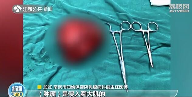 女子患罕见乳腺肿瘤 一年内疯长大如足球