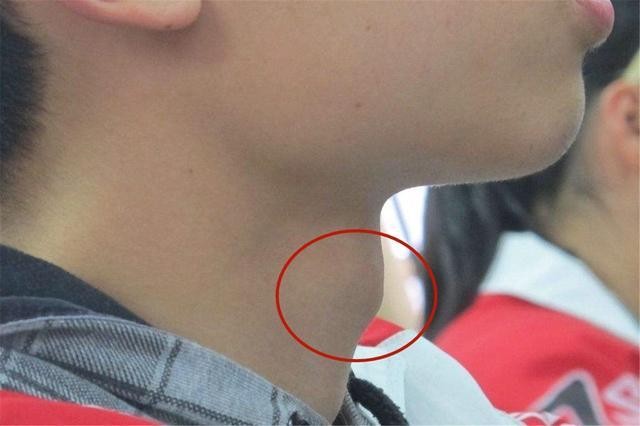 13歲男孩160cm，骨骺線快要閉合，提醒：出現2個特徵前，抓緊補救