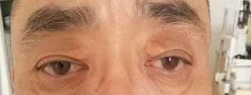 科普——眼整形手术是个什么手术?(多图)