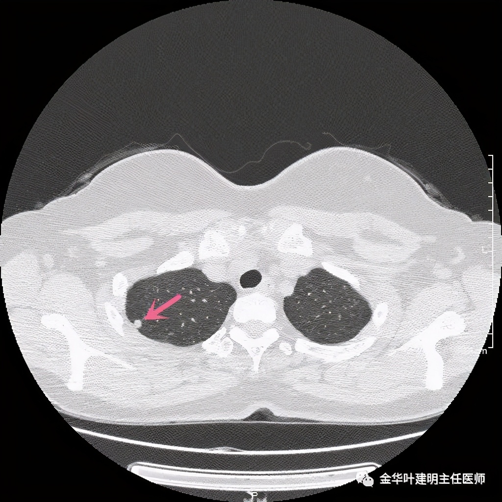 随访明显增大的实性<!--HAODF:8:jiejiebing-->肺结节<!--HAODF:/8:jiejiebing-->肯定是癌吗？要不要手术？