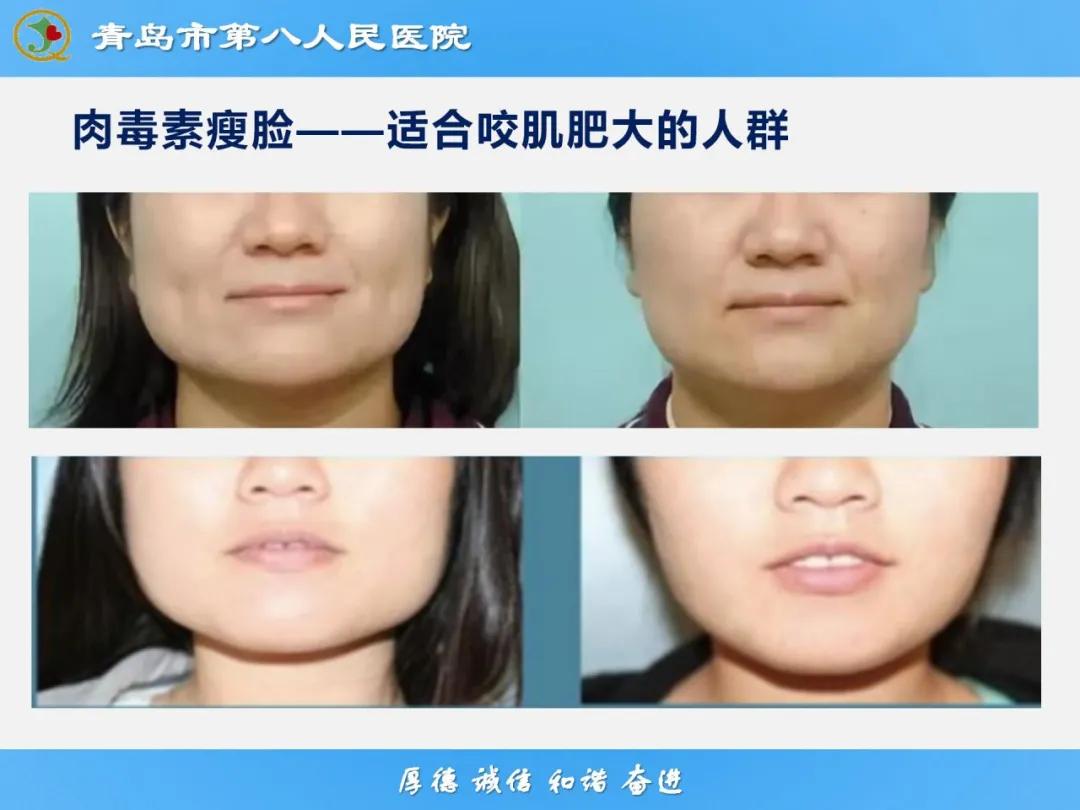 健康科普大赛获奖作品展示⑭丨肉毒毒素微整注射