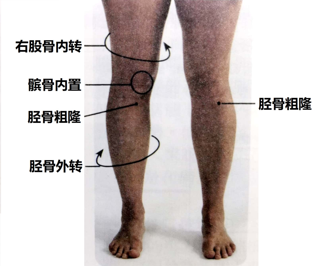 不能盘腿那就鸭子坐 跪坐 不好意思 也是不良姿势 X型腿 X型腿