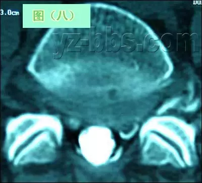 手把手教你：腰椎间盘突出CT和MRI读片技巧