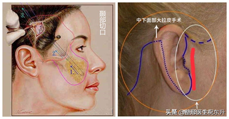 扒一扒“小拉皮和大拉皮”的区别