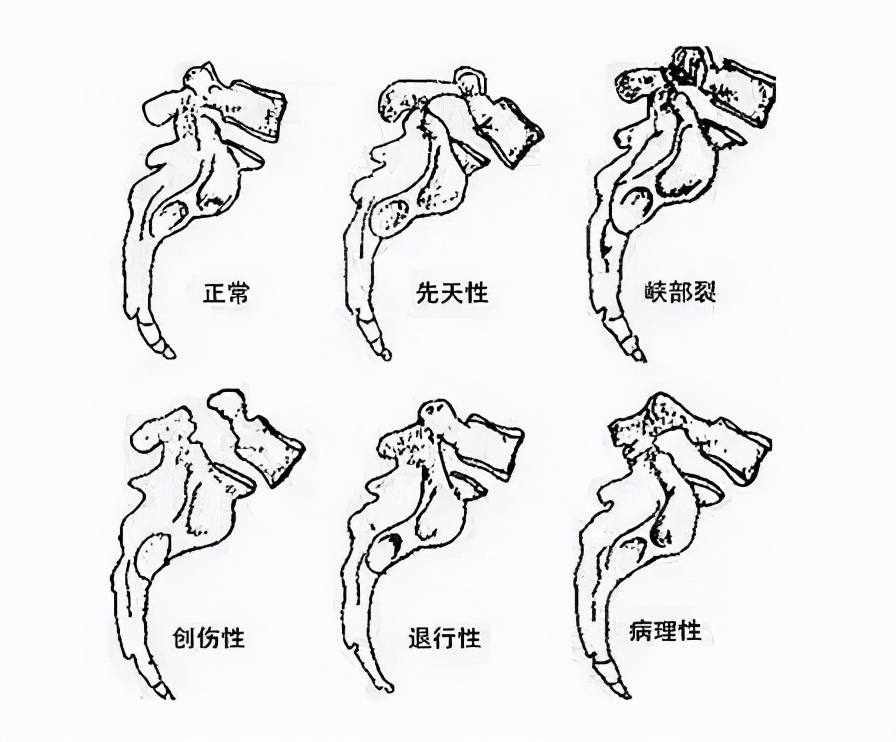 路医生说丨&ldquo;腰椎滑脱&rdquo;，究竟是个什么鬼，是腰椎脱位了么？