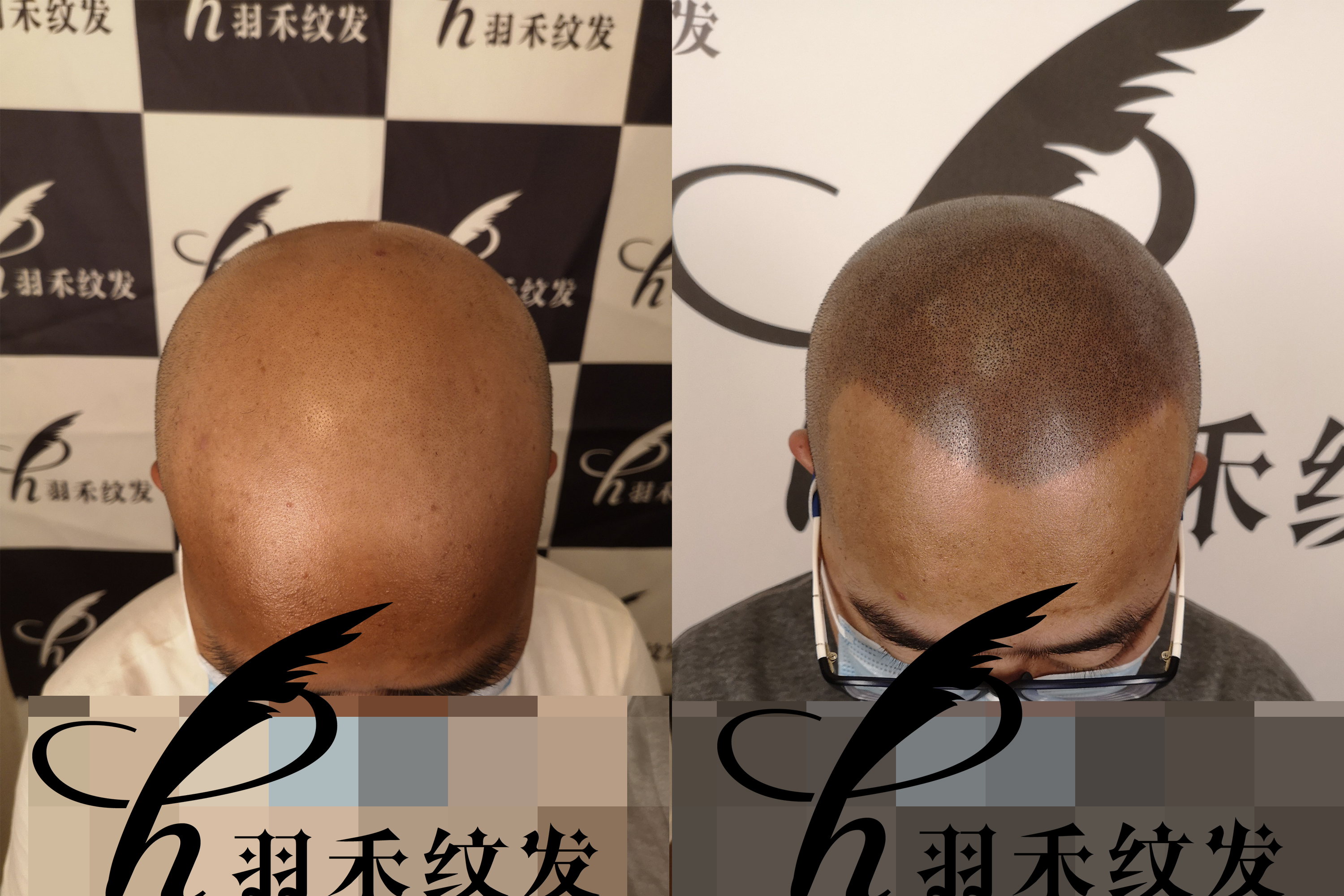 纹发后还能戴假发吗？