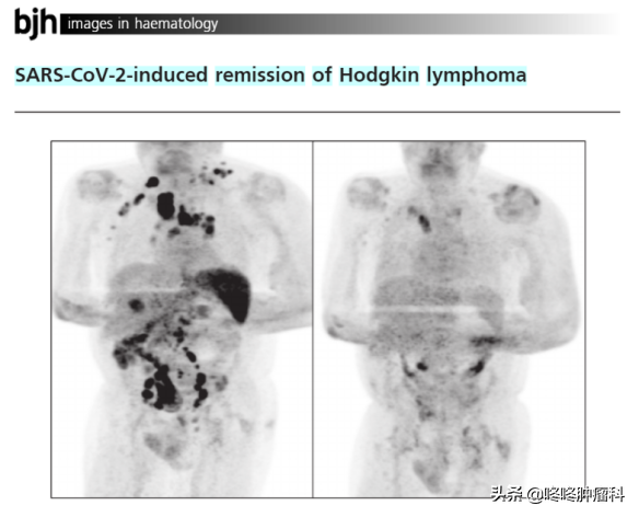 不可思議：得了新冠肺炎，腫瘤卻消失了？