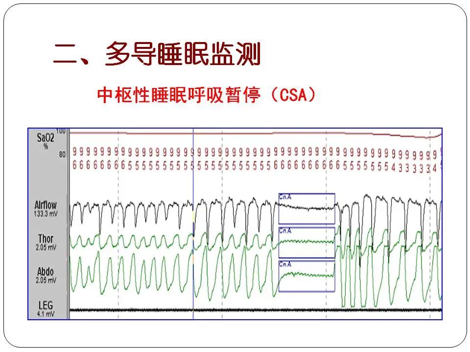 “睡眠呼吸暂停与心血管风险”健康大课堂