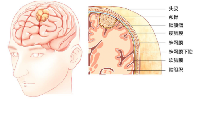 头痛会不会是得了脑瘤呢？医生提醒：这些常见的脑瘤需要注意