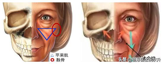 法令纹又称"鼻唇沟"，属于条状"凹陷"，别只想着"填充"