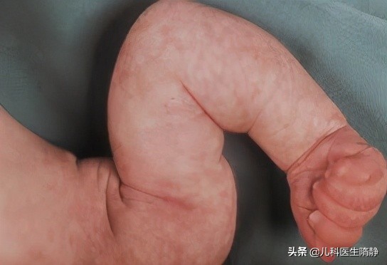 新生児 中 毒性 紅斑