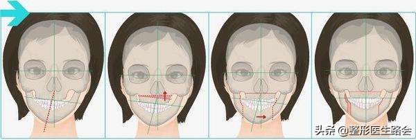 关于脸型，左右完全不对称的脸还能怎么改善？