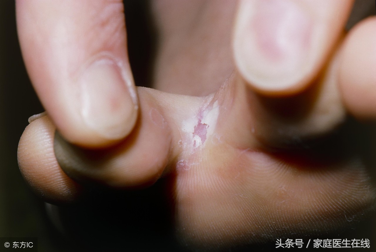 用盐水泡脚，可辅助治疗脚气病？医生的答案，却让人意外