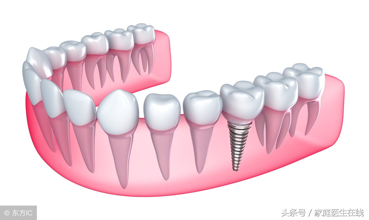 缺牙后有这三种修复方式，但适用人群各不同