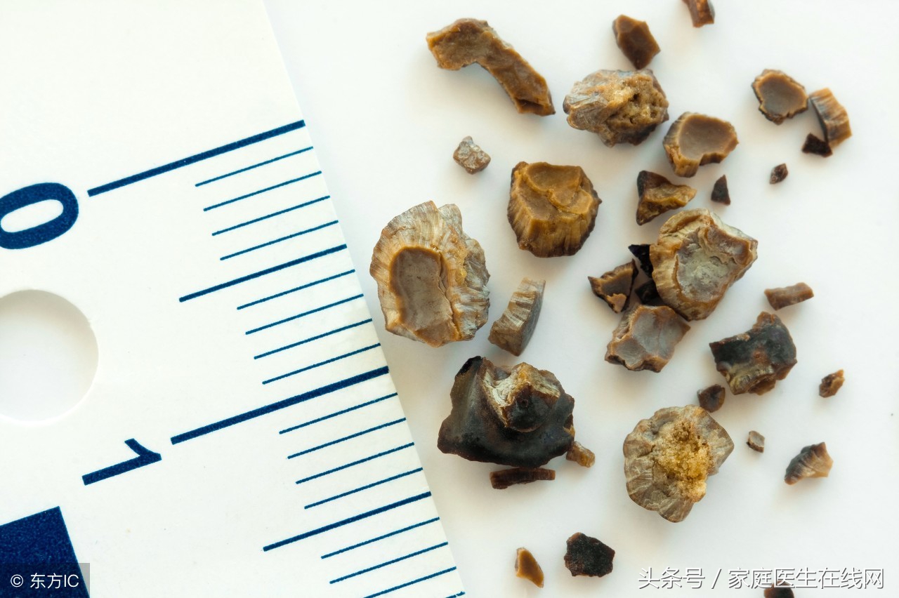 治疗胆结石时，配合这3种食物，身体康复得更快