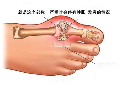 脚趾头疼痛的常见原因总结及处理方法
