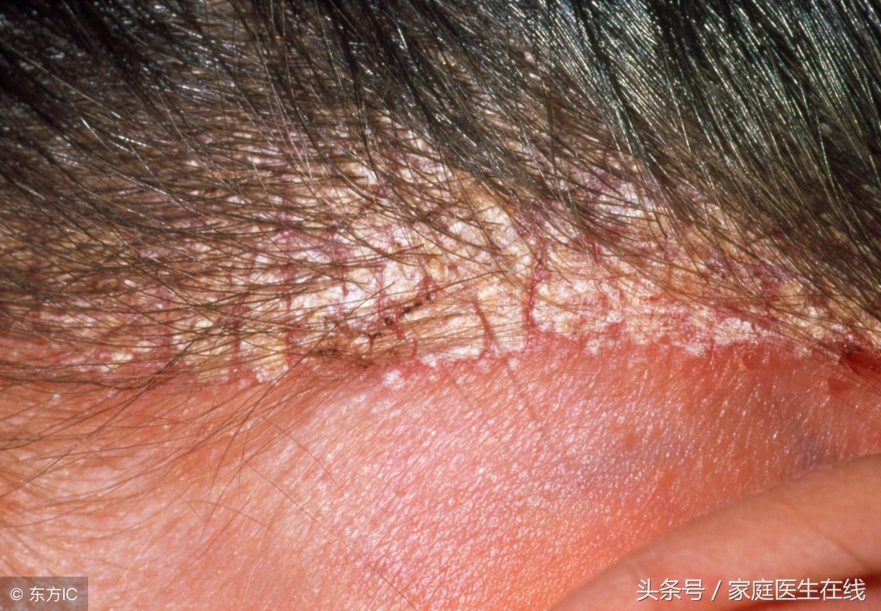 皮肤上长红色小点，不一定是痘痘，而是这个病！