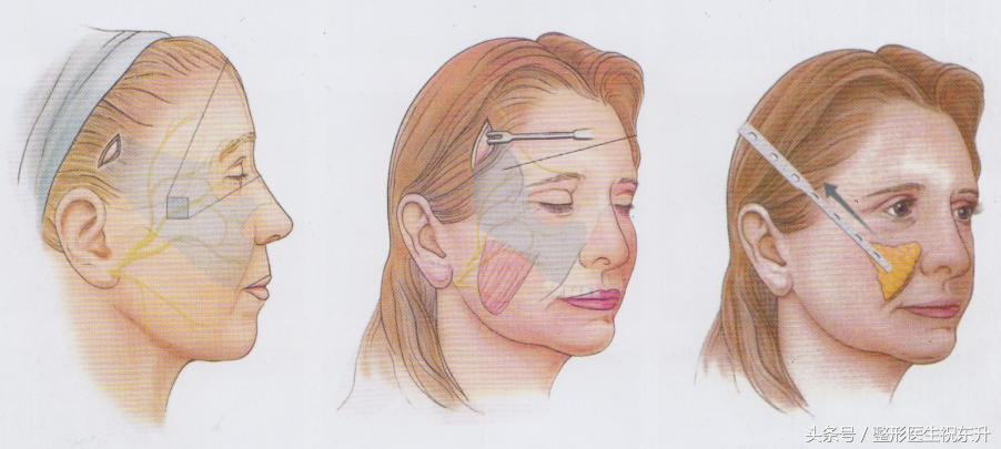 面部松弛下垂必须做大拉皮手术吗？