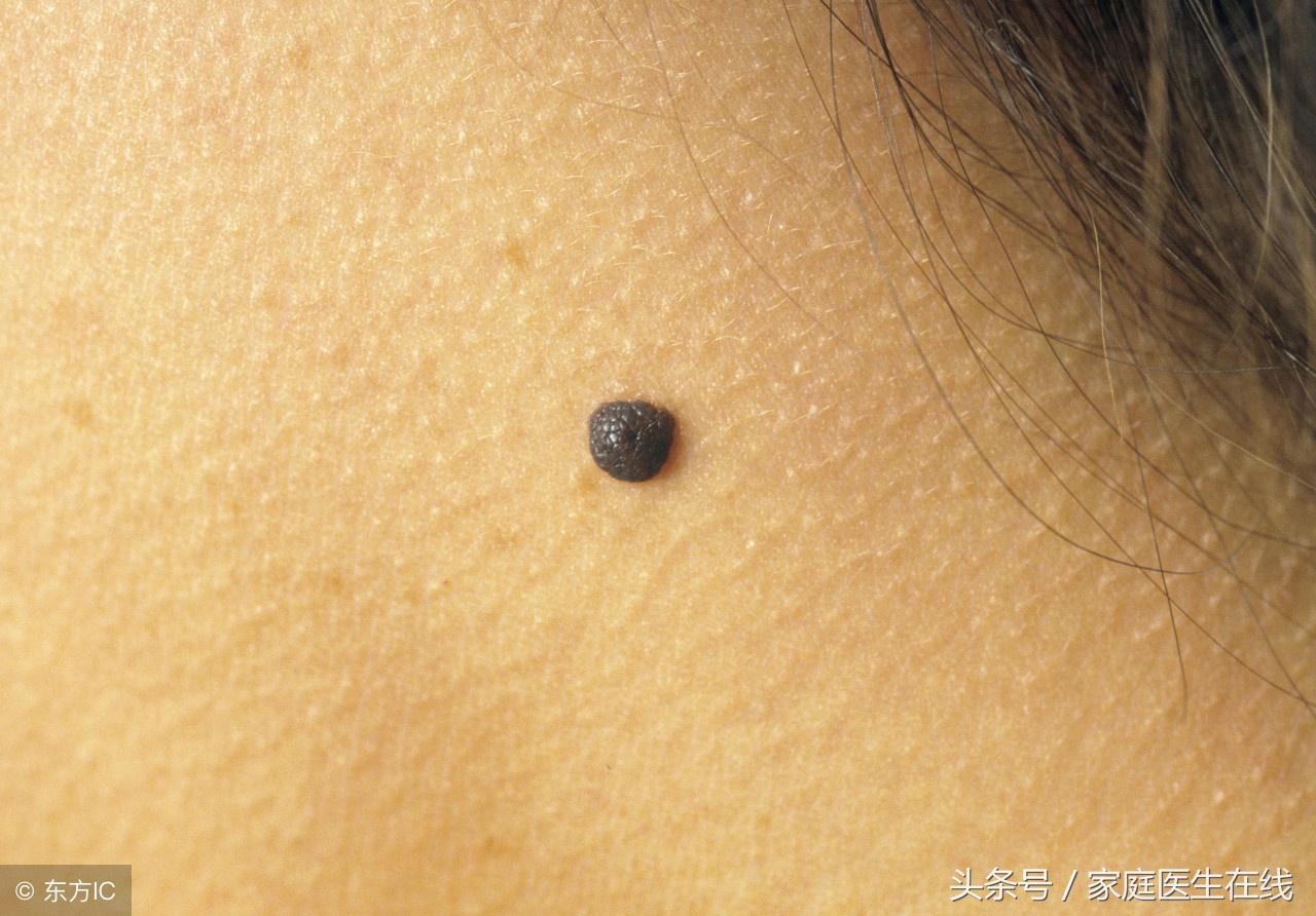 如何除痣?这三种方法,安全又有效!