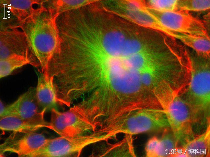 首次研究巨型癌细胞，能带来突破性的治疗？