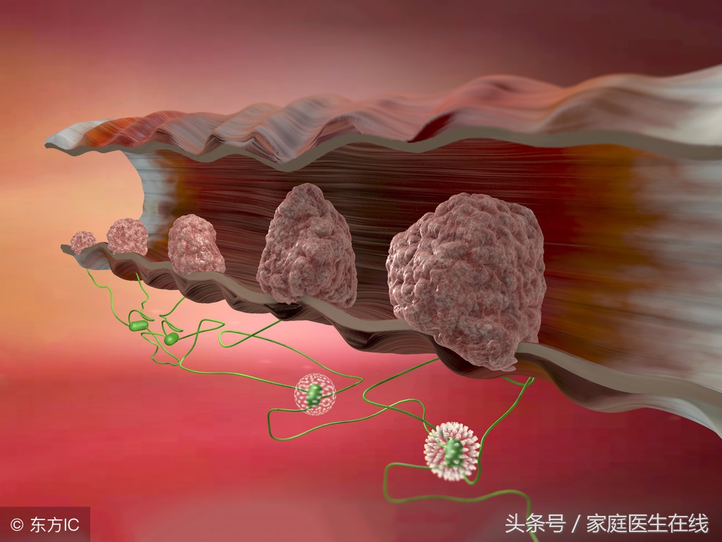 大肠癌的早期症状 有这4种症状 - 学堂在线健康网