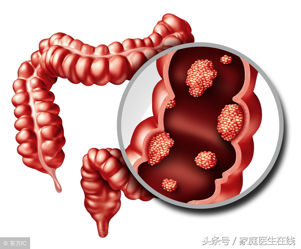 警惕！直肠癌5大早期症状，收到“信号”快治疗