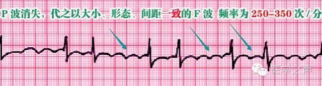 这么教你看心电图，还有什么理由看不懂？