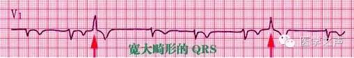 这么教你看心电图，还有什么理由看不懂？