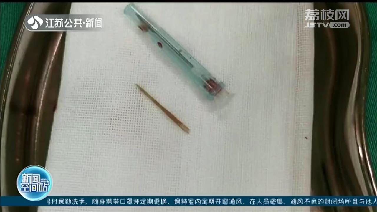 南通大叔感染性休克送进ICU 医生从肝脏里取出半截牙签