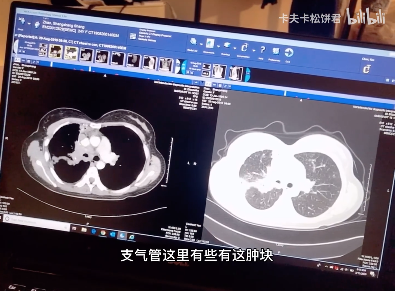 95后波士顿女留学生患肺癌去世了，生前她曾被网