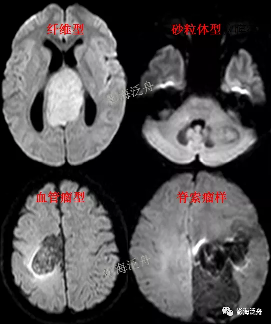 一个病例，让你深刻理解什么是异病同影