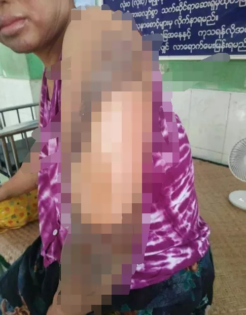 女子脚上、身体大面积烫伤，缅甸政府送来250元慰问金
