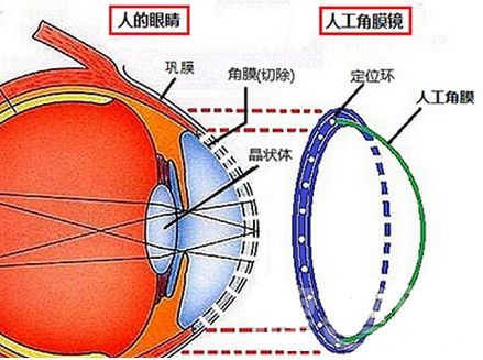 国产人工角膜要来了！那一天，他们终将“看”到