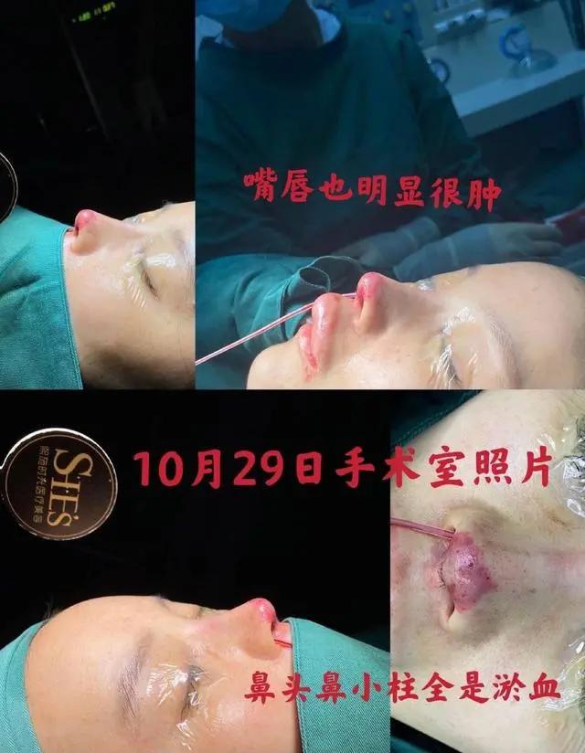 女演员自曝整形失败,涉事医美机构一年内被罚5次