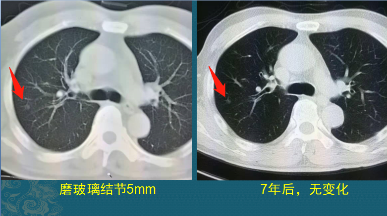 磨玻璃肺结节随访观察，会不会变成肺癌？医生带你看随访4种结局