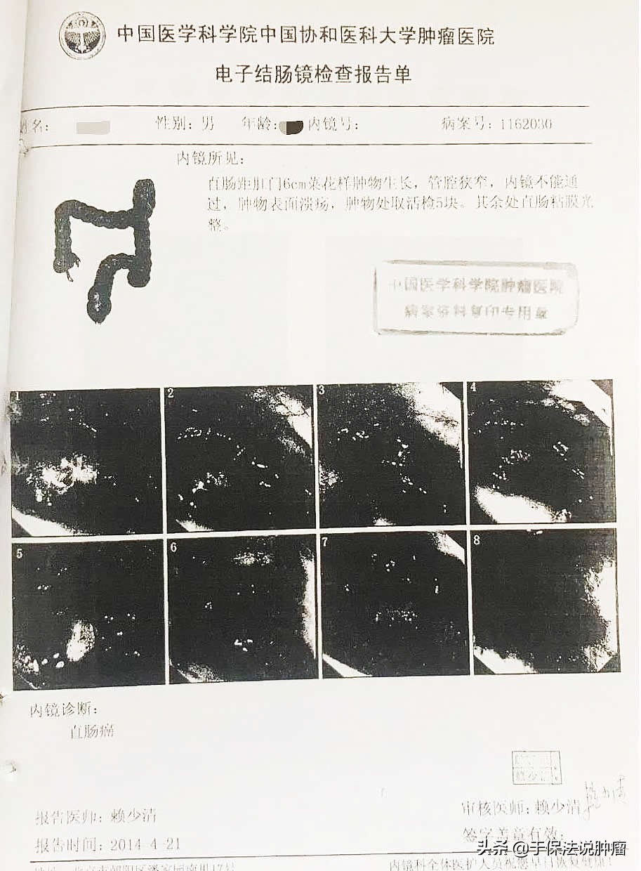 直肠癌侵达浆膜外无法手术，经缓释库治疗，现生存超过7年